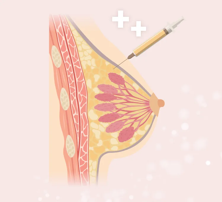 自體脂肪隆乳作用原理-桃園隆乳推薦