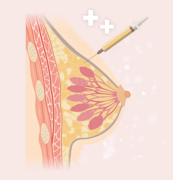 自體脂肪隆乳作用原理-桃園隆乳推薦