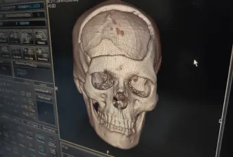 3D電腦斷層評估臉型-桃園削骨手術推薦