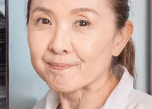 法令紋明顯-桃園臉部拉皮手術