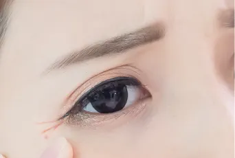 雙眼皮修復需求者-桃園割雙眼皮推薦
