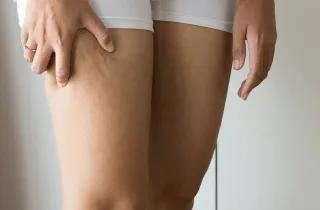 大腿抽脂-桃園動力抽脂