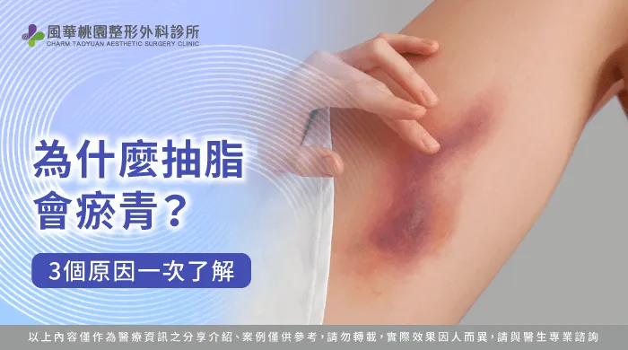 為什麼抽脂會瘀青-抽脂手術 瘀青