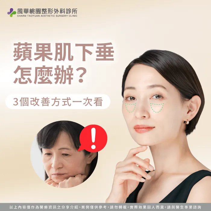蘋果肌下垂怎麼辦-蘋果肌下垂