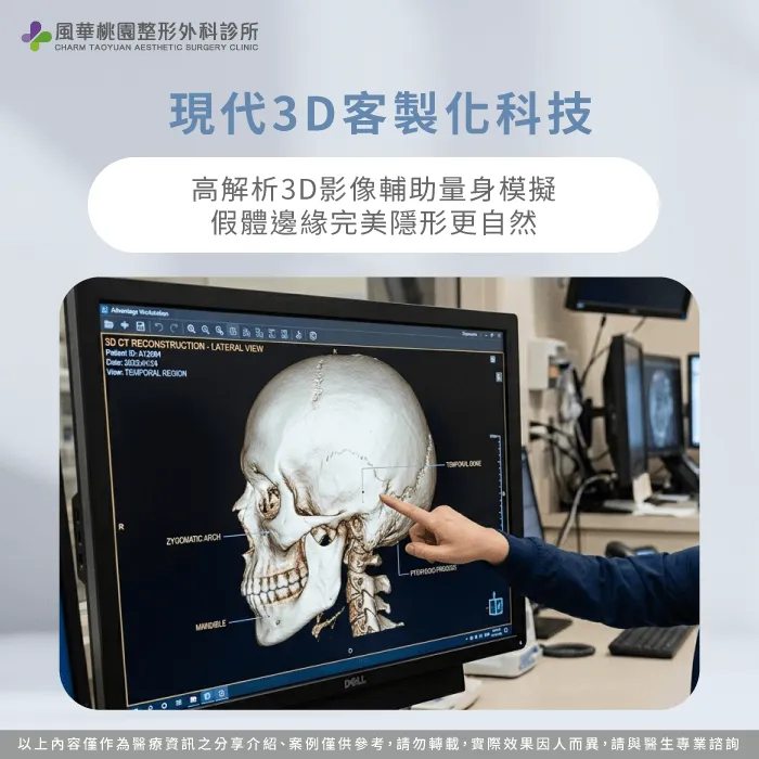利用高解析電腦斷層掃描訂製邊緣完美隱形的專屬假體 現代3D客製化骨水泥技術-成人扁頭矯正