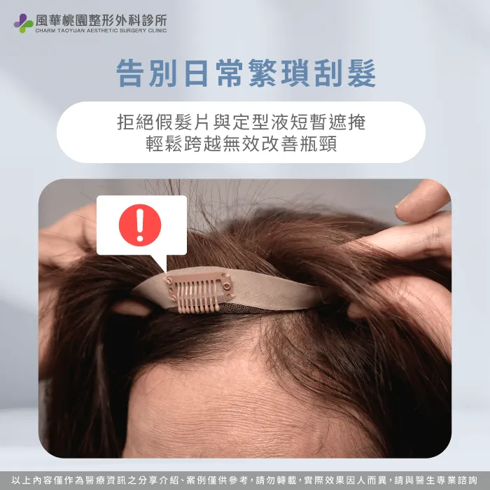 刮髮與配戴假髮片遮掩方式耗時且容易因活動漏洞而位移 假髮片與定型液視覺侷限-成人扁頭矯正