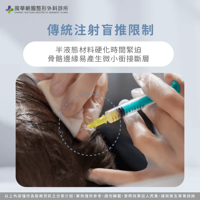 早期注射方式操作時間緊迫且考驗醫師盲推的經驗 早期半液態骨水泥塑形-大人扁頭矯正