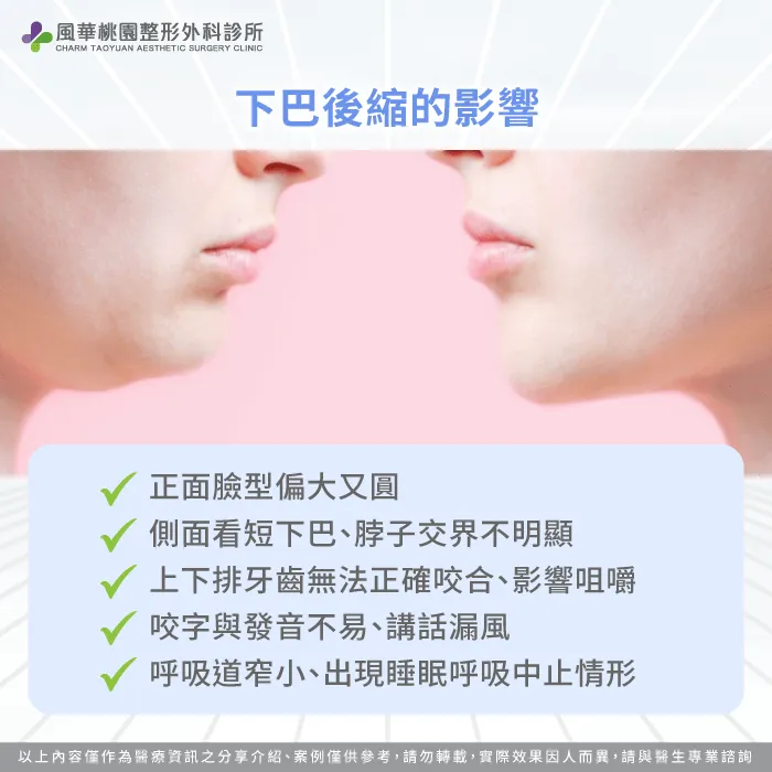 下巴後縮影響-下巴後縮墊下巴