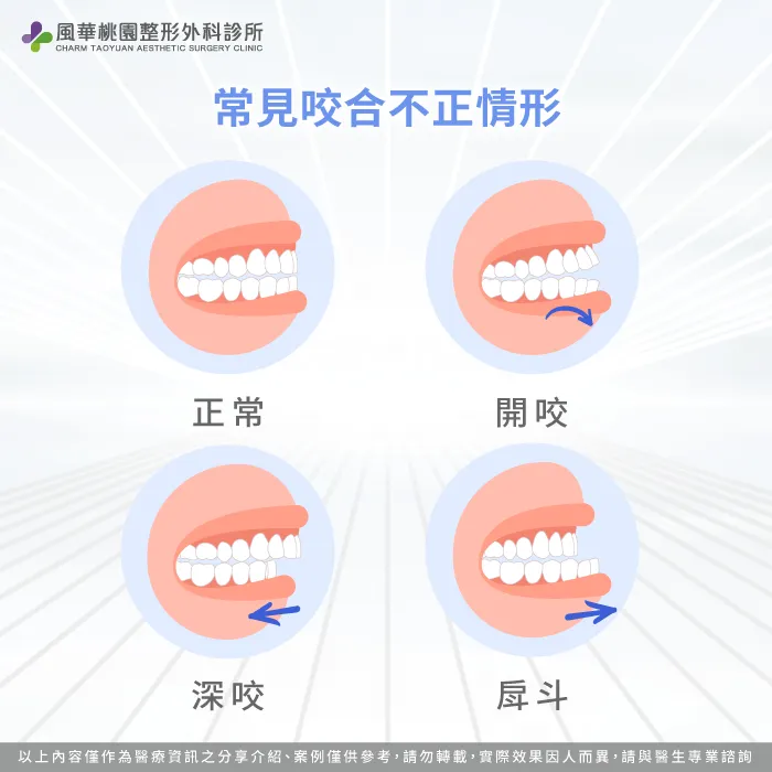 咬合不正情形-下巴後縮正顎