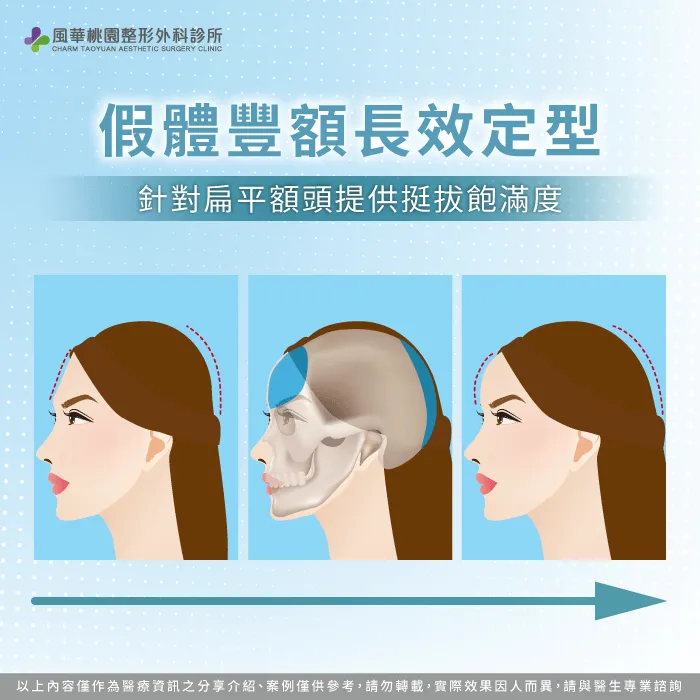 解析假體豐額手術優勢-豐額手術方式