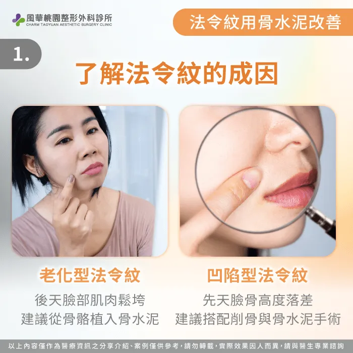 為什麼會有法令紋-法令紋骨水泥