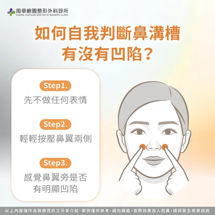 如何判斷鼻溝槽凹陷-骨水泥法令紋