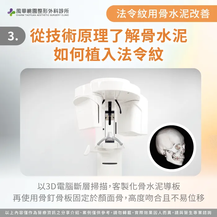 骨水泥植入法令紋的原理-法令紋骨水泥