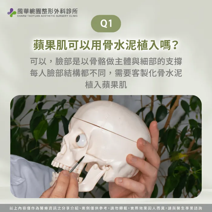 蘋果肌凹陷可以用骨水泥植入嗎-蘋果肌凹陷 骨水泥