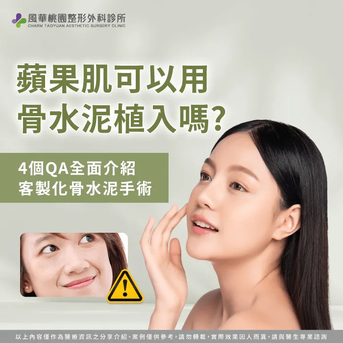 蘋果肌凹陷 骨水泥-蘋果肌凹陷 骨水泥