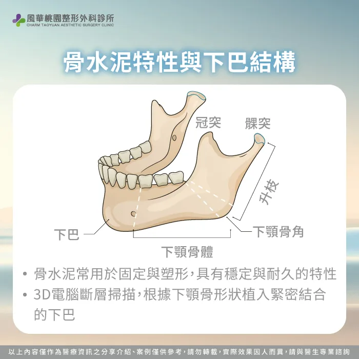 骨水泥特性與下巴結構-骨水泥 墊下巴