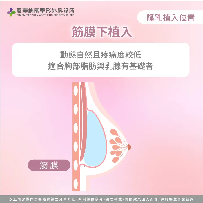 筋膜下植入假體-隆乳切口位置