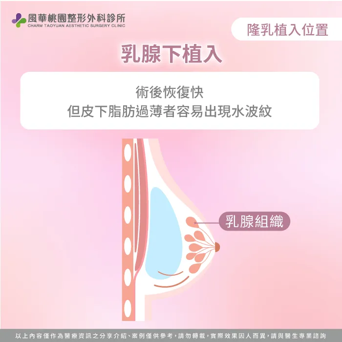 乳腺下植入假體-隆乳切口差異