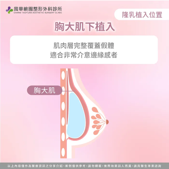 胸大肌下植入假體-隆乳切口差異