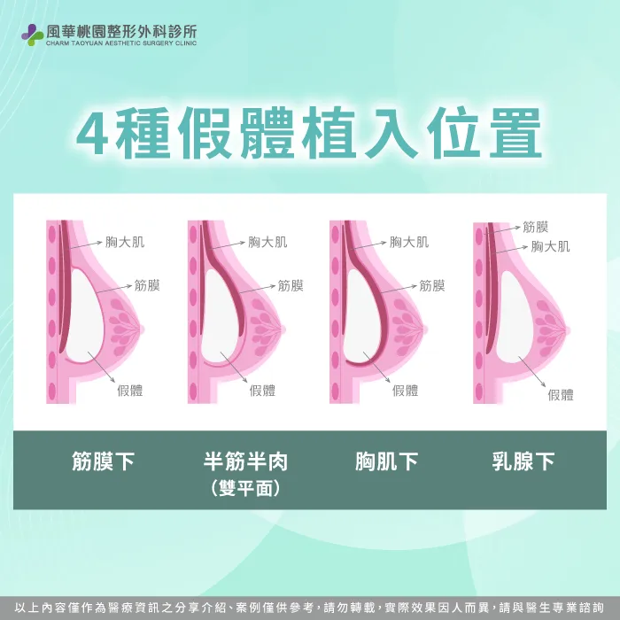 隆乳手術位置-隆乳後會下垂嗎