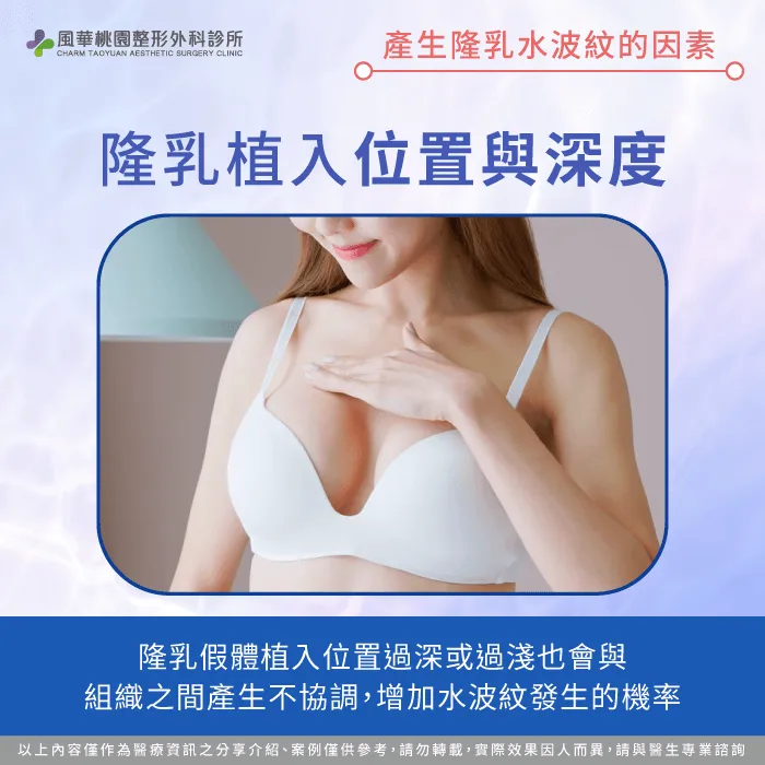 隆乳植入位置與深度-隆乳水波紋是什麼
