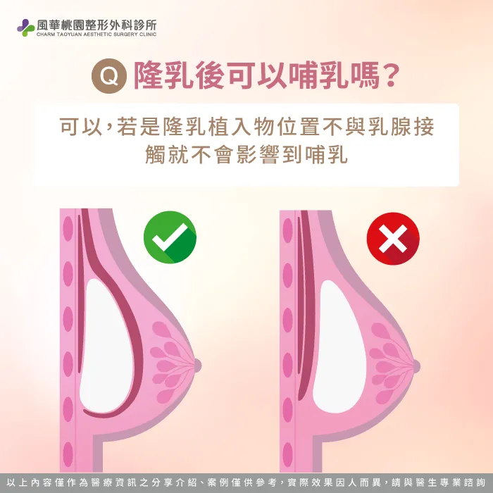 隆乳後哺乳可以嗎-隆乳可以哺乳嗎