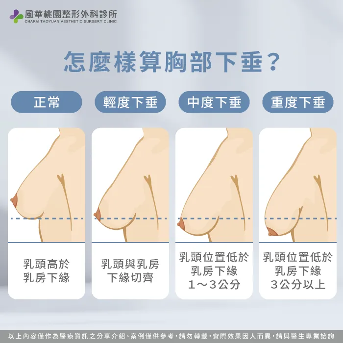 怎麼評估自己有沒有胸部下垂-胸部下垂怎麼辦