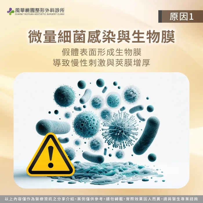 高品質無菌手術環境能顯著降低自體免疫因受刺激而發炎的風險 微量細菌生物膜引發莢膜變硬-隆乳莢膜攣縮是什麼