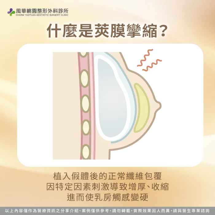 透過專業整形外科角度深度剖析建立精準的日常照護觀點 深度剖析隆乳莢膜攣縮是什麼成因-莢膜攣縮是什麼