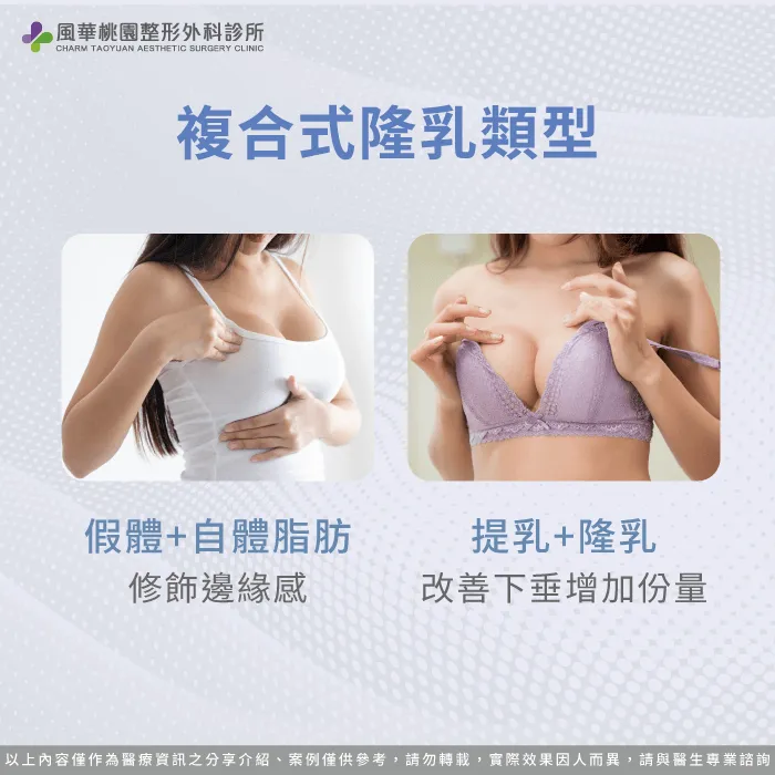 複合式隆乳類型-複合式隆乳