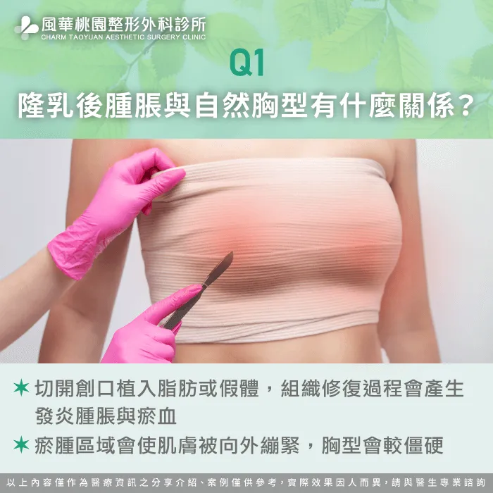 隆乳後腫脹-隆乳後多久自然