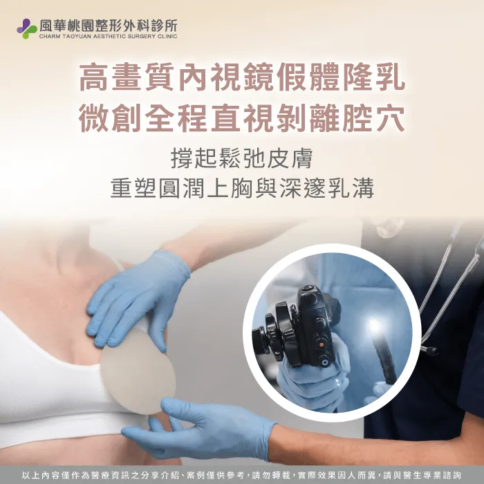 透過微創內視鏡精準植入高品質假體,有效解決產後胸部萎縮帶來的空杯困擾。 內視鏡假體隆乳打造立體飽滿胸型-產後胸部萎縮