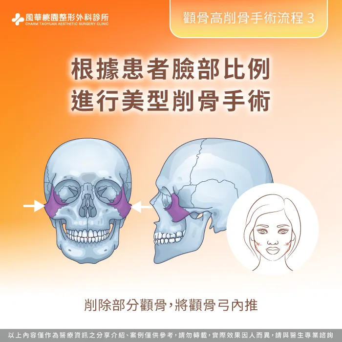 根據患者臉部比例進行美型削骨手術-顴骨高削骨
