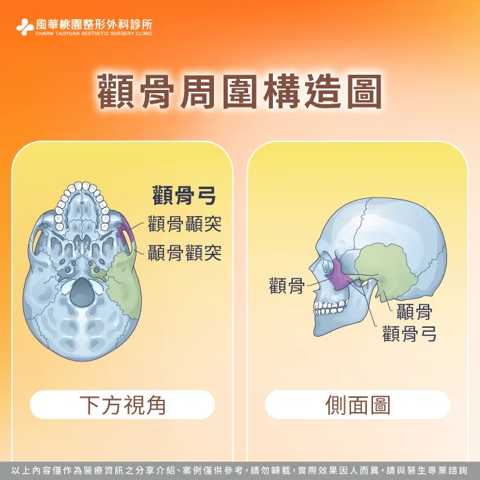顴骨位置構造-顴骨高削骨