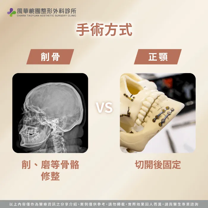 手術方式-削骨 正顎 差別