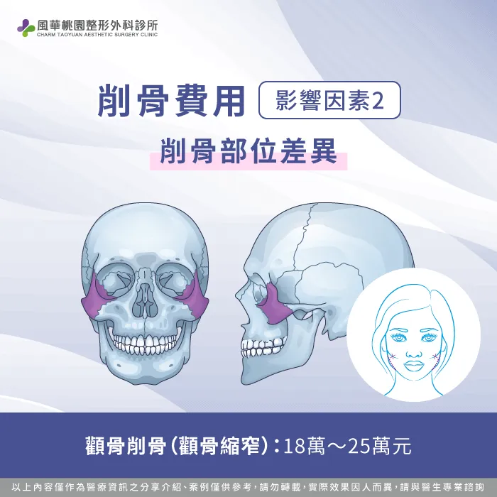 顴骨削骨手術費用-削骨費用