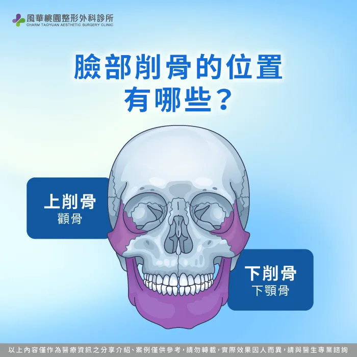 介紹常見的臉部削骨位置,如下顎骨角與顴骨等部位的調整方式 臉部削骨位置有哪些-臉寬 削骨