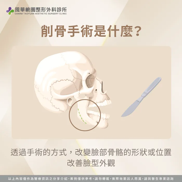 削骨手術是什麼-削骨是什麼