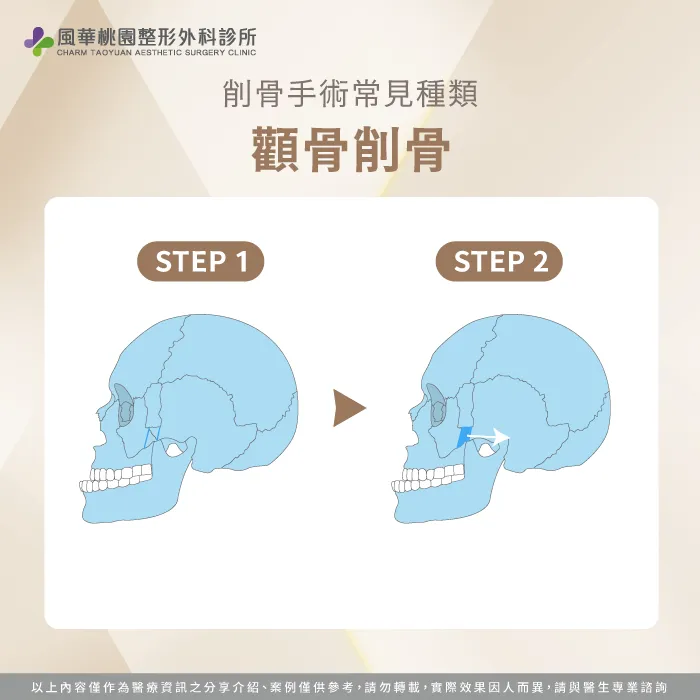 顴骨削骨-削骨是什麼