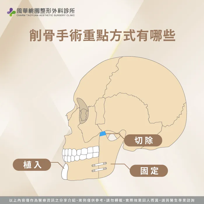 削骨手術重點-削骨是什麼