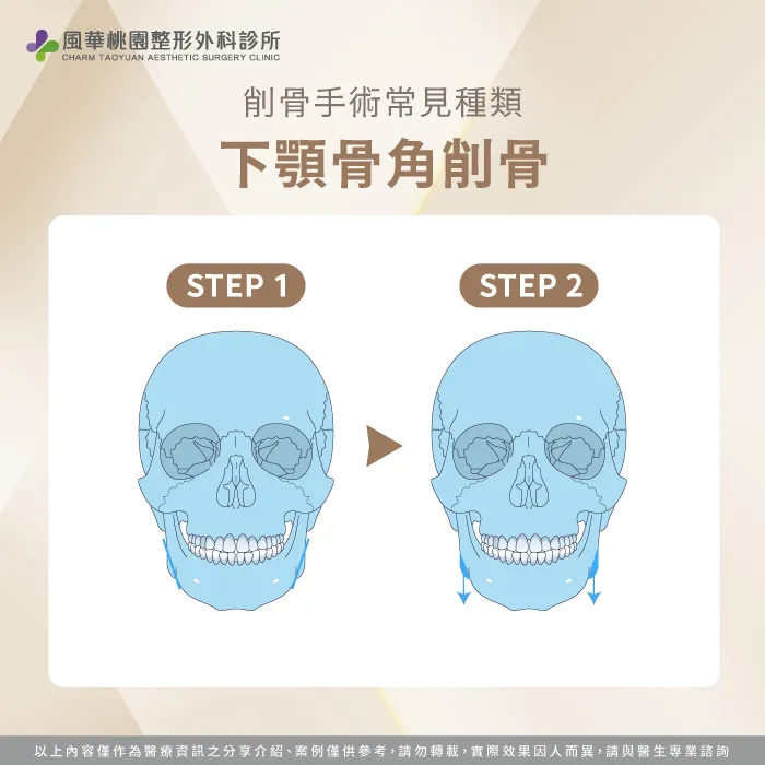 下顎骨角削骨-削骨是什麼