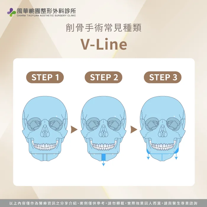 V-Line-削骨是什麼
