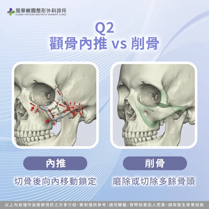 顴骨內推跟顴骨削骨手術有何不同-顴骨高削骨