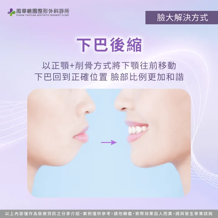 下巴後縮-臉大 削骨
