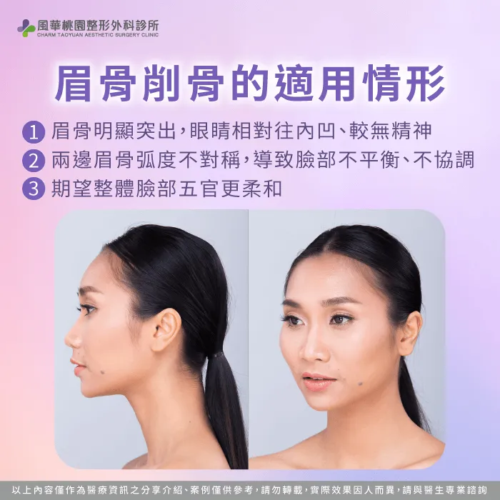眉骨削骨的適用情形-眉骨削骨