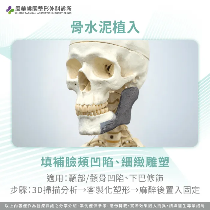 骨水泥置入-臉型不對稱削骨