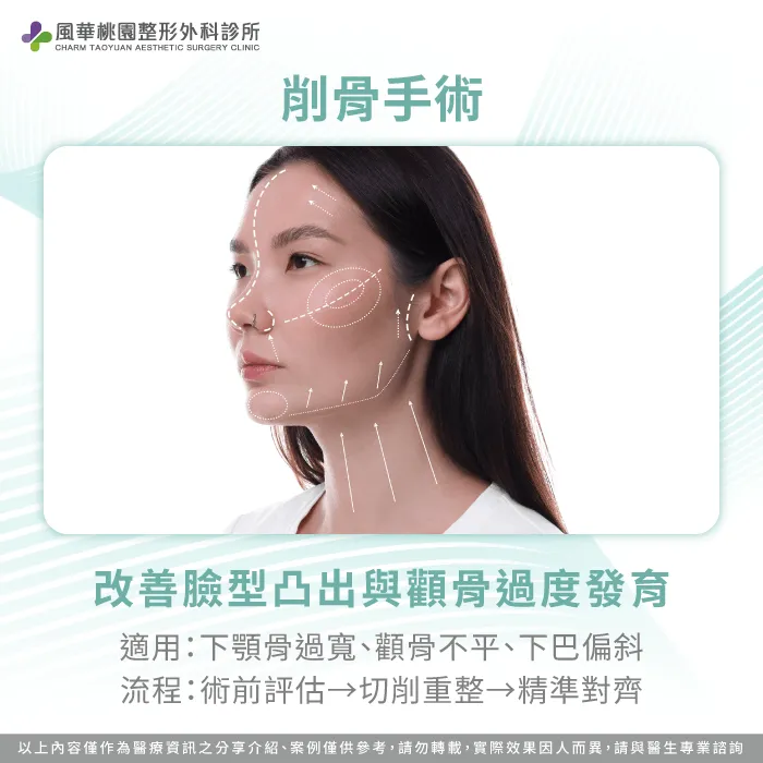 削骨手術-臉型不對稱削骨