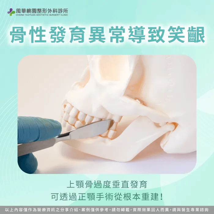 上顎骨過度垂直發育-笑齦 正顎