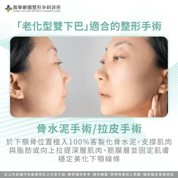 使用客製化骨水泥植入下顎骨,支撐肌肉與脂肪,長期穩定美化下顎線條,延緩老化影響,也可以透過中下臉拉皮手術雕塑輪廓 老化型雙下巴-雙下巴手術