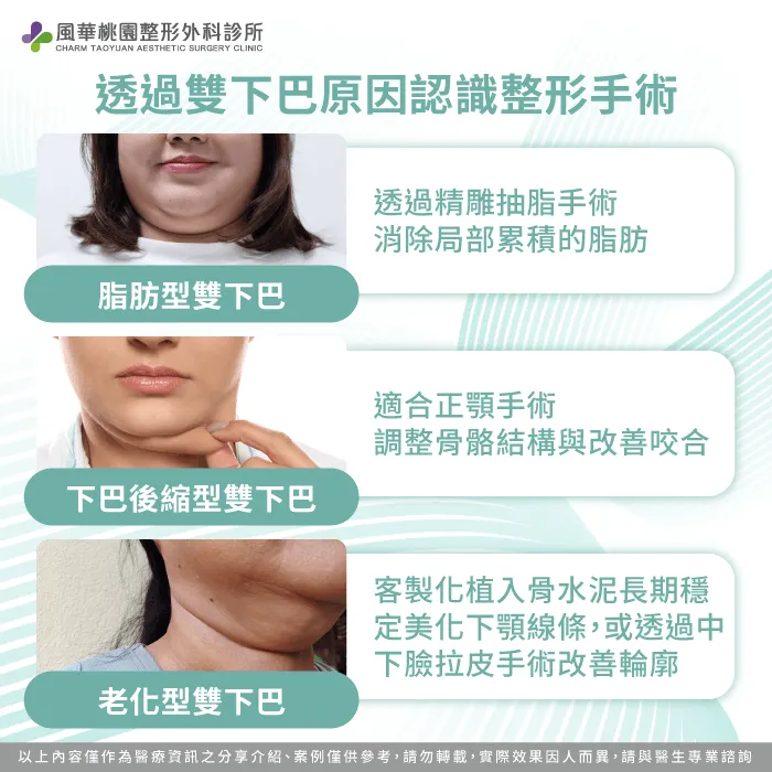 立即了解不同成因的雙下巴情形,適合的整形手術有哪些 雙下巴整形手術有哪些-雙下巴手術